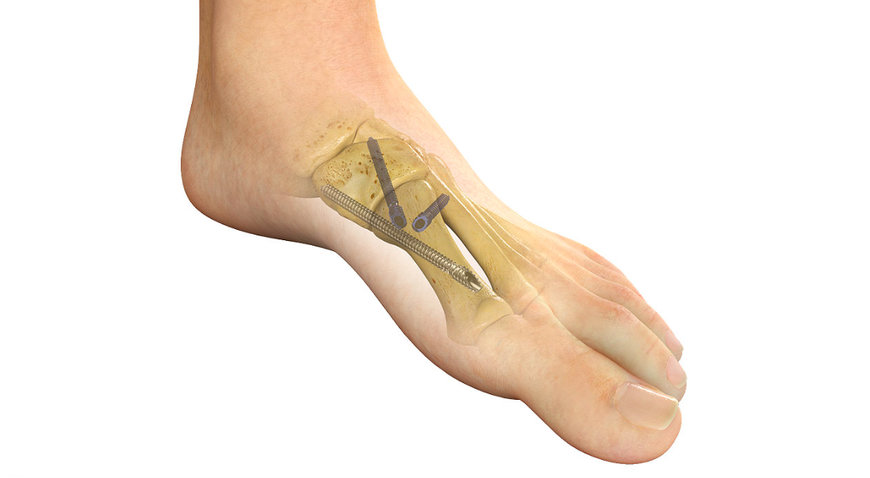 STRYKER LAUNCHES NEW MINIMALLY INVASIVE SURGICAL OPTION FOR TREATING PATIENTS WITH BUNIONS